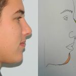 Chin Augmentation Before & After Patient #1195
