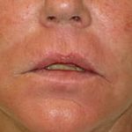 Fraxel Laser Resurfacing Before & After Patient #1174