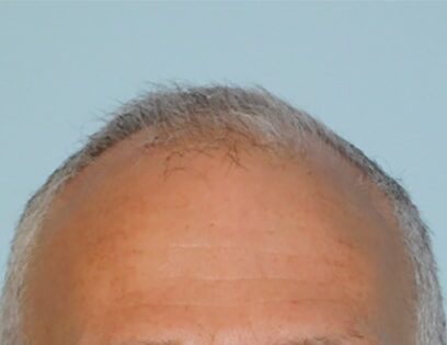 Before Photo of Hair Transplant Smartgraft in Philadelphia