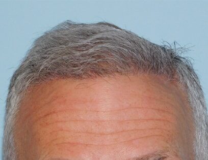 After Photo of Hair Transplant Smartgraft in Philadelphia