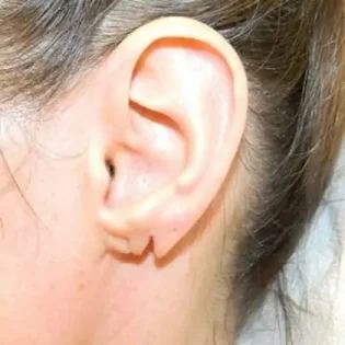 Before Photo of Earlobe Repair in Philadelphia