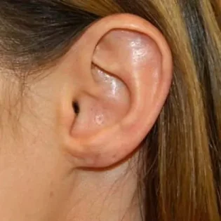 After Photo of Earlobe Repair in Philadelphia