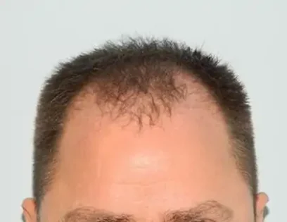 Before Photo of Hair Transplant Smartgraft in Philadelphia