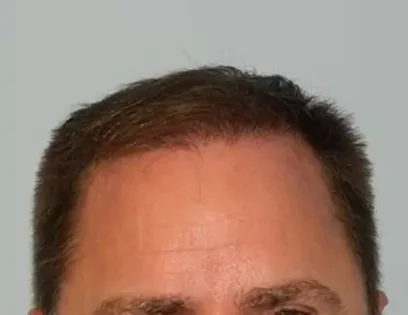 After Photo of Hair Transplant Smartgraft in Philadelphia