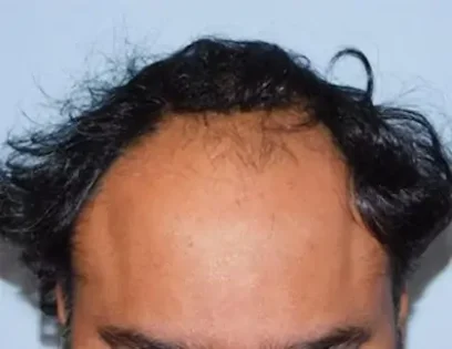 Before Photo of Hair Transplant Smartgraft in Philadelphia