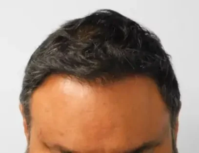 After Photo of Hair Transplant Smartgraft in Philadelphia