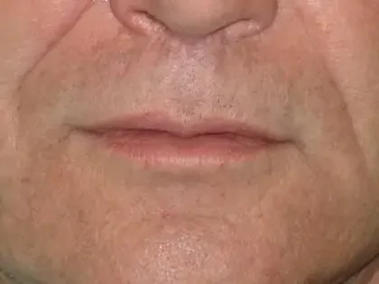 After Photo of Lip Lift in Philadelphia