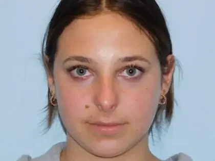 Before Photo of Rhinoplasty in Philadelphia