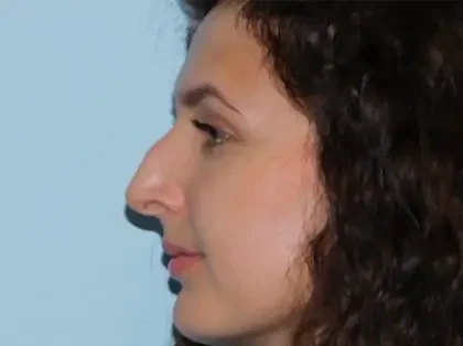 Before Photo of Rhinoplasty in Philadelphia