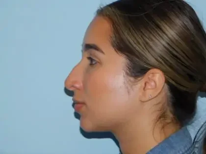 Before Photo of Rhinoplasty in Philadelphia