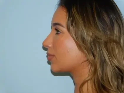 After Photo of Rhinoplasty in Philadelphia