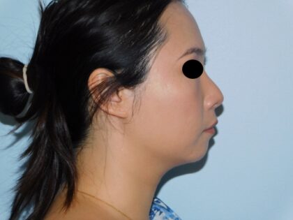 Before Photo of Injectable Fillers in Philadelphia