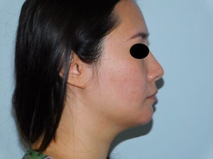 After Photo of Injectable Fillers in Philadelphia