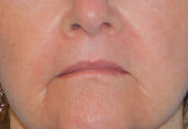 After Photo of Lip Lift in Philadelphia