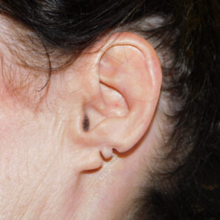 Before Photo of Earlobe Repair in Philadelphia