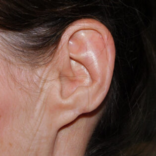 After Photo of Earlobe Repair in Philadelphia