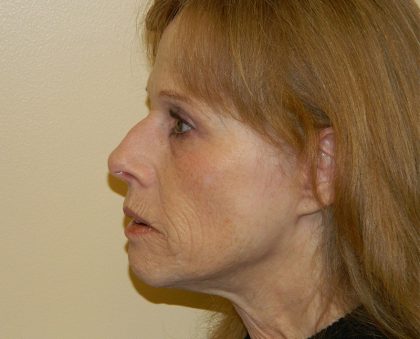 Brow Lift Before & After Patient #3227