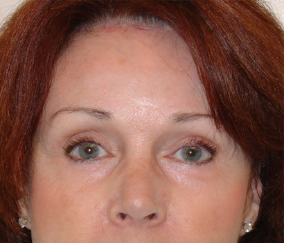 Brow Lift Before & After Patient #3232
