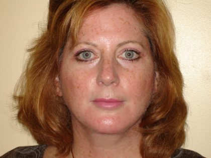 Blepharoplasty Before & After Patient #3185