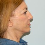 Mini Facelift Before & After Patient #2783