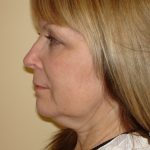 Mini Facelift Before & After Patient #2748