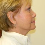 Mini Facelift Before & After Patient #2746