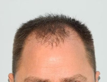 Hair Transplant Smartgraft Before & After Patient #1400