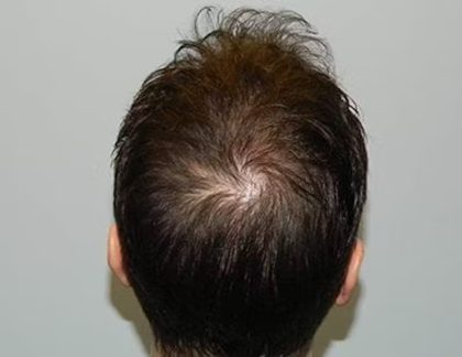 Hair Transplant Smartgraft Before & After Patient #1350