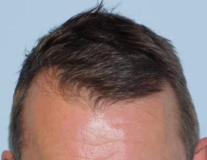 Hair Transplant Smartgraft Before & After Patient #1364