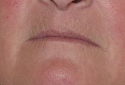 Lip Lift Before & After Patient #1268