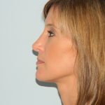 Rhinoplasty Before & After Patient #2866