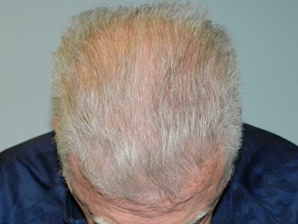 Hair Transplant Smartgraft Before & After Patient #1347
