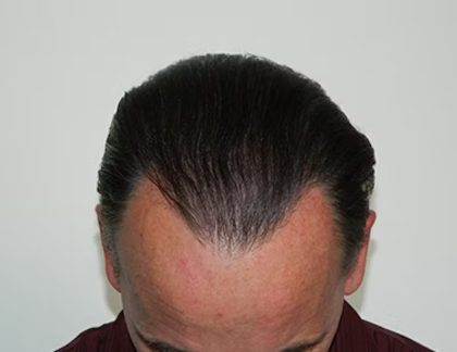 Hair Transplant Smartgraft Before & After Patient #1399