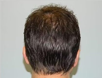 Hair Transplant Smartgraft Before & After Patient #1350
