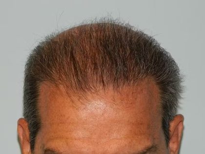 Hair Transplant Smartgraft Before & After Patient #1352