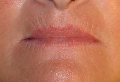 Lip Lift Before & After Patient #1268
