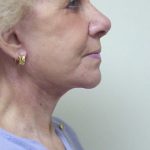 Traditional Facelift Before & After Patient #1690