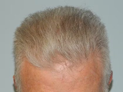 Hair Transplant Smartgraft Before & After Patient #1347