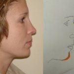 Rhinoplasty Before & After Patient #2672