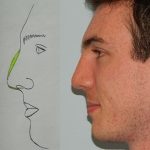 Rhinoplasty Before & After Patient #2656