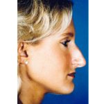 Rhinoplasty Before & After Patient #2654