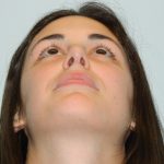 Rhinoplasty Before & After Patient #2640