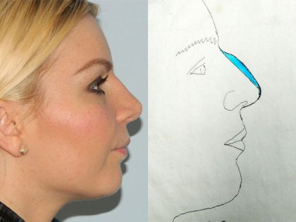 Rhinoplasty Before & After Patient #3045