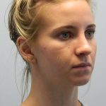 Rhinoplasty Before & After Patient #2937