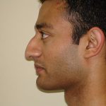 Rhinoplasty Before & After Patient #3062