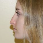 Rhinoplasty Before & After Patient #2681