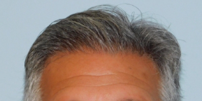 Hair Transplant Smartgraft Before & After Patient #3577