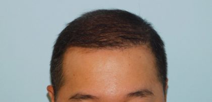 Hair Transplant Smartgraft Before & After Patient #3637