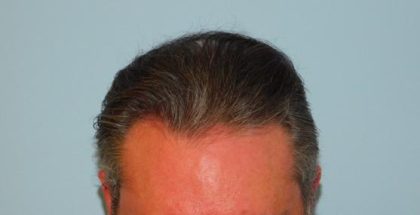 Hair Transplant Smartgraft Before & After Patient #3640